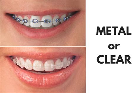 metal braces with clear brackets|ceramic brackets vs metal.